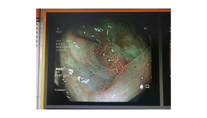 Image of large intestinal mucosa in figure 1 as seen by NBI. A small tumor is easily visible in this image as shown by arrow