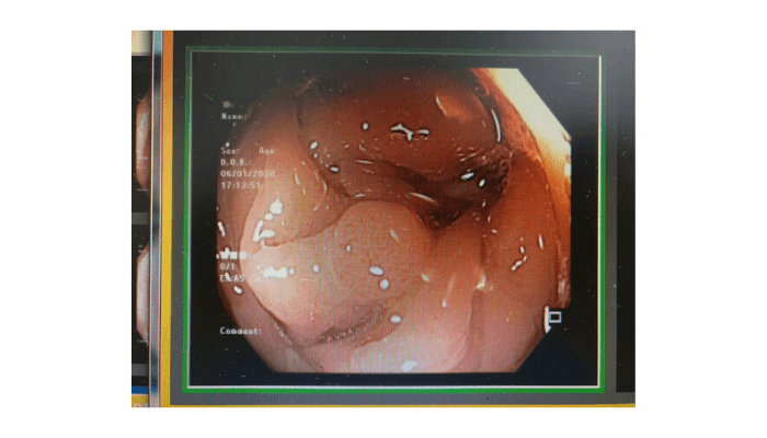 Image of large intestinal mucosa as seen by white light endoscopy