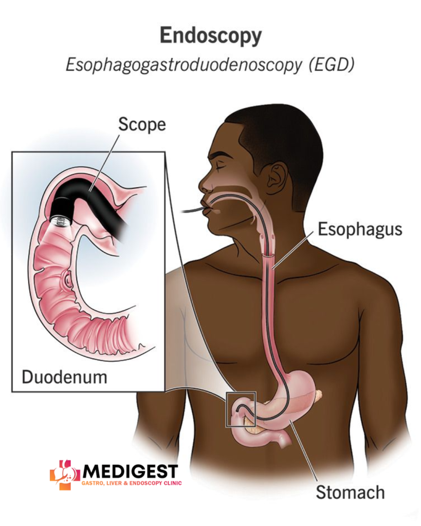 image showing about upper GI endoscopy