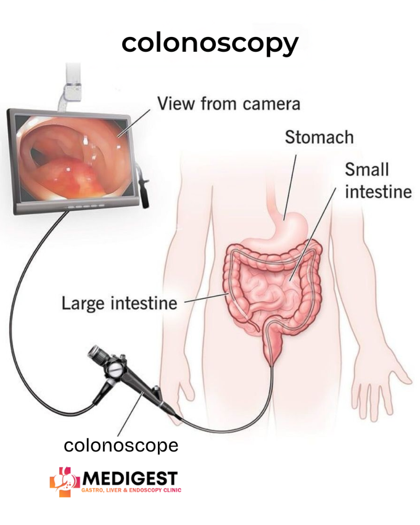 image showing colonoscopy