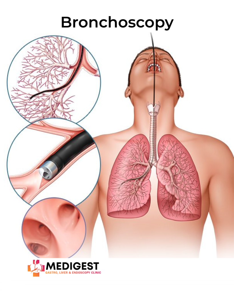 Bronchoscopy