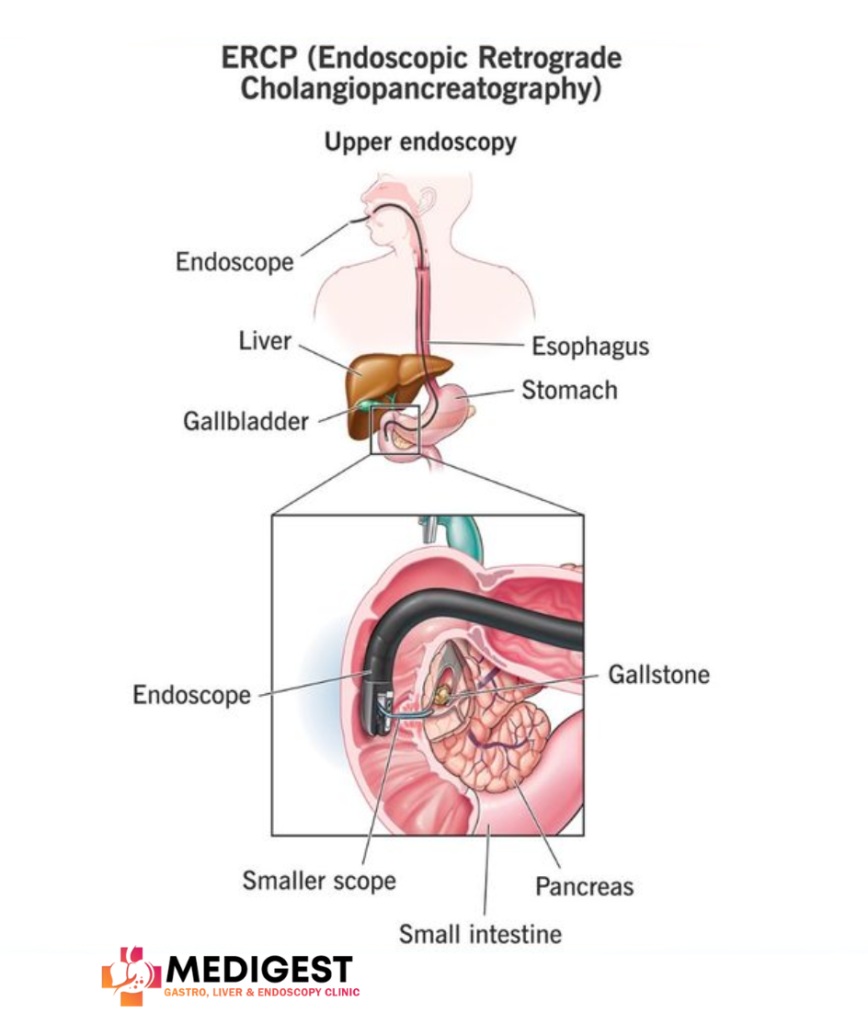 Endoscopic Retrograde Cholangiopancreatography (ERCP)