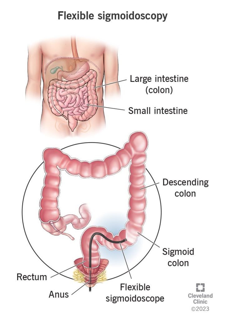 Sigmoidoscopy
