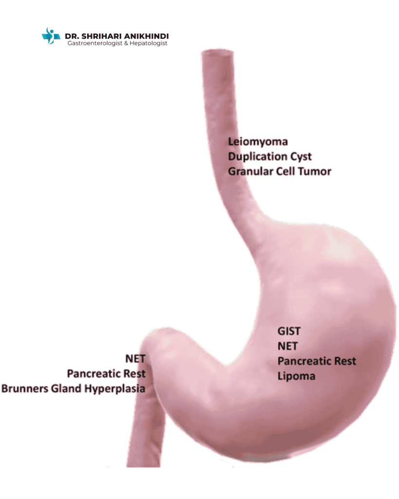Upper Gastrointestinal Subepithelial Lesions