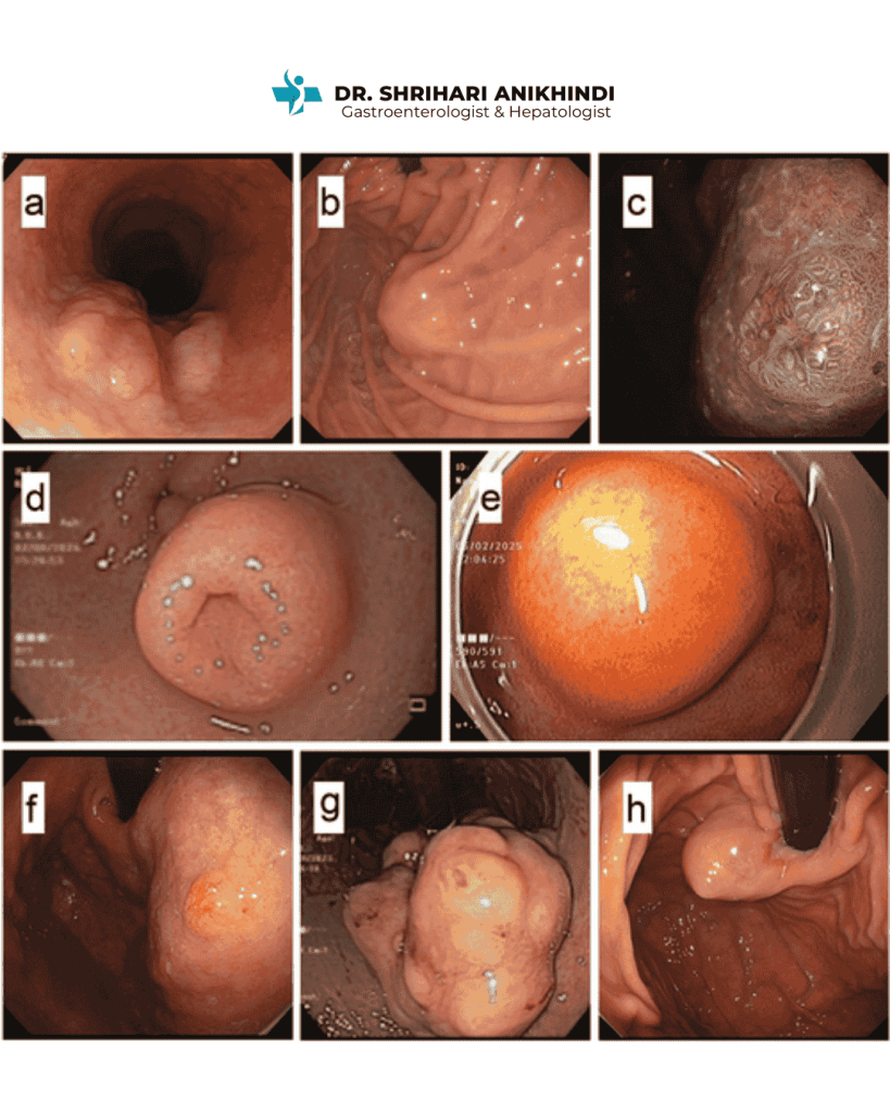 Upper Gastrointestinal Subepithelial Lesions